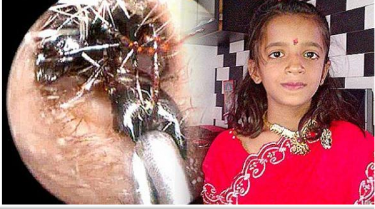 اكتشاف بيت نمل في أذن طفلة هندية