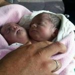 سوريا:ولادة طفل برأسين