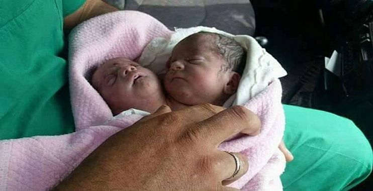 سوريا:ولادة طفل برأسين